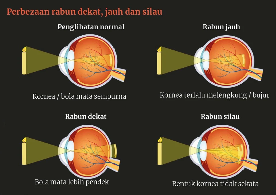 Terdapat 3 jenis rabun, jauh, dekat dan silau