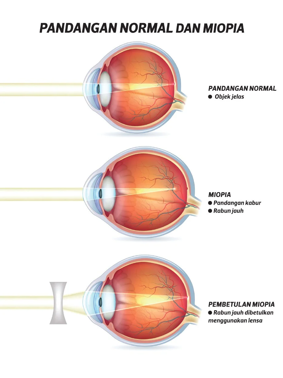 Gambaran visual bagaimana kornea rabun jauh