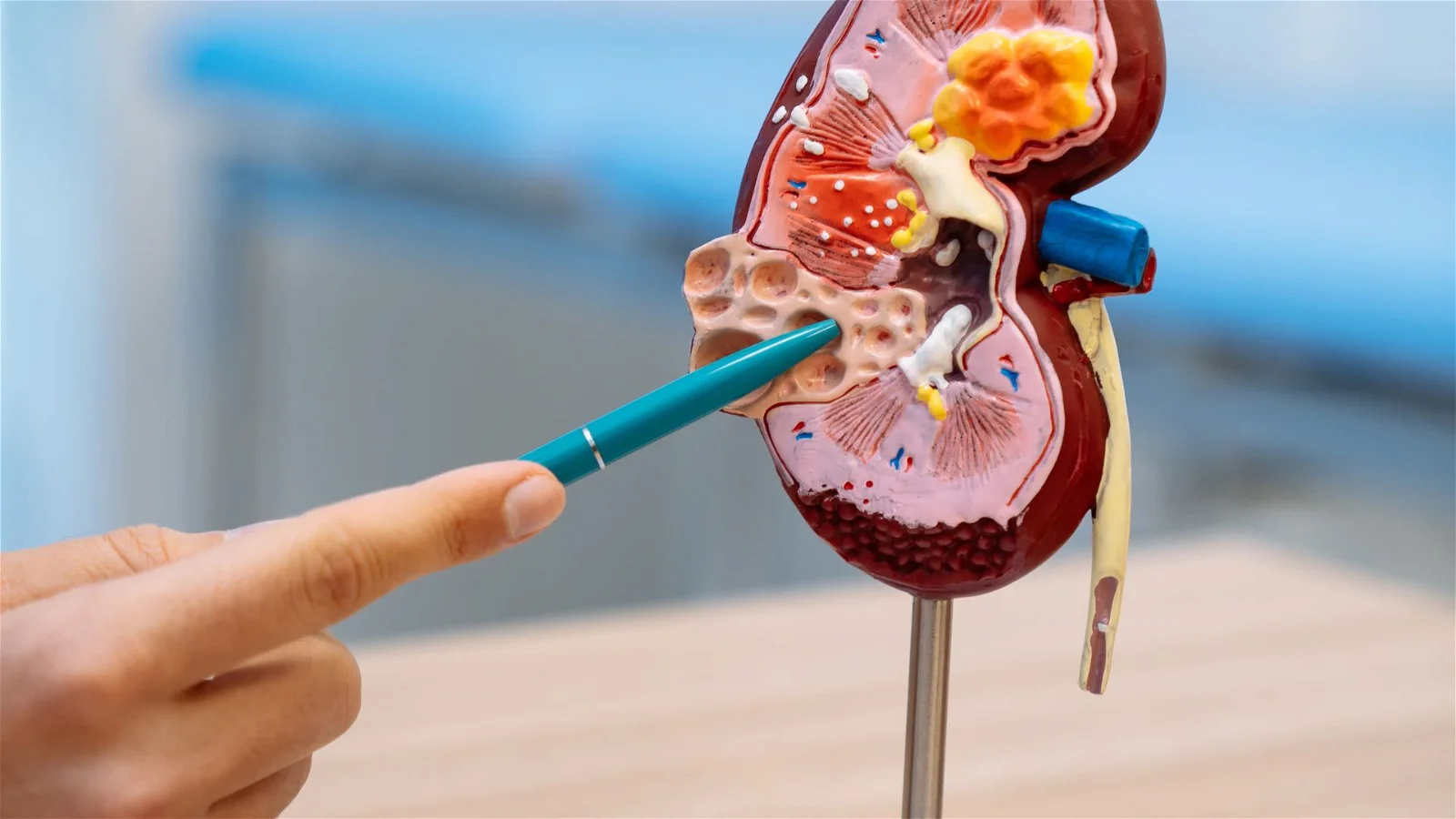 Minum air kelapa sekarang untuk kurnagkan batu gijin