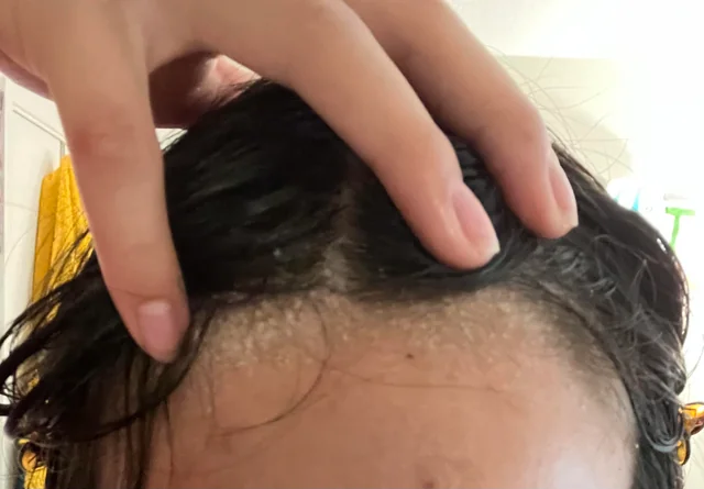 Contoh kulit kepala kering yang boleh buat rambut kita lebih rosak tau